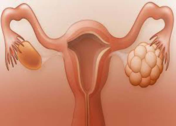 Suy buồng trứng ở nữ giới do nguyên nhân nào và có thai được không?